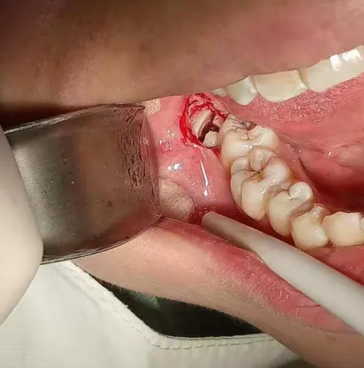 横着长的智齿确实比普通智齿更难拔,但通过规范操作基本都能顺利