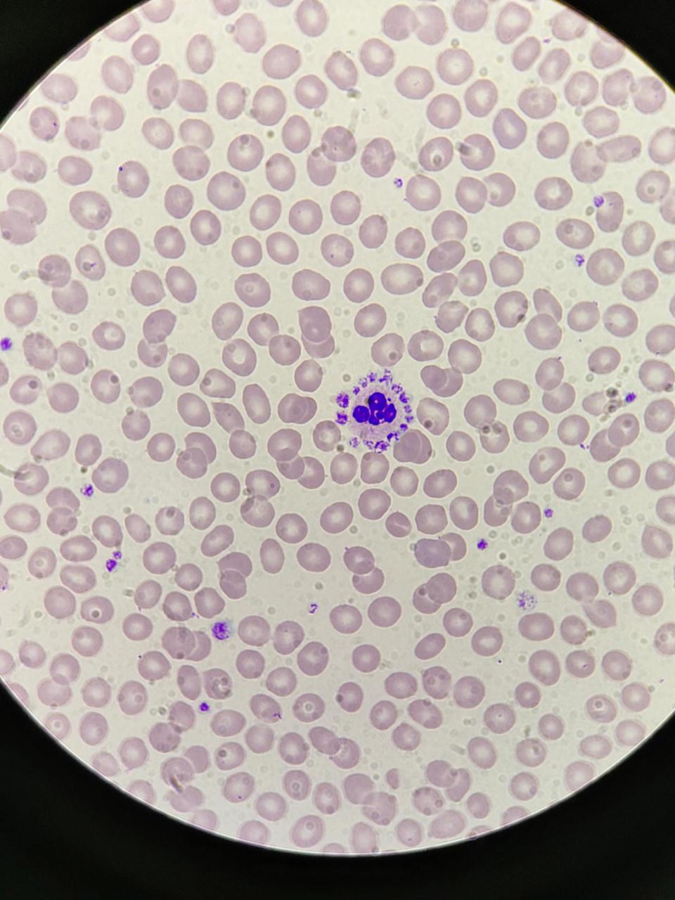 血小板卫星现象959595 97血小板卫星现象:血小板黏附,围绕于