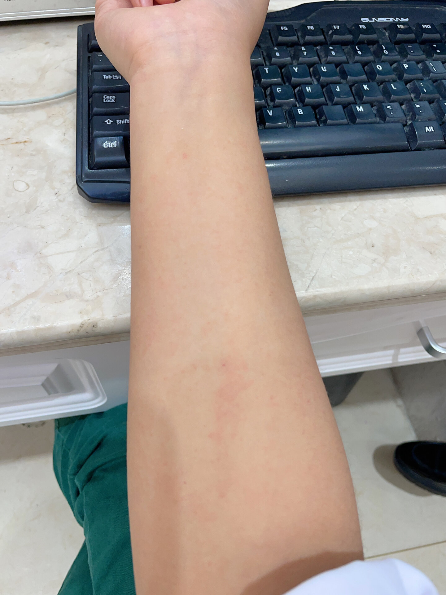胳膊又又又痒 某天突然开始过敏  前前后后快半个月了 每次快好点的