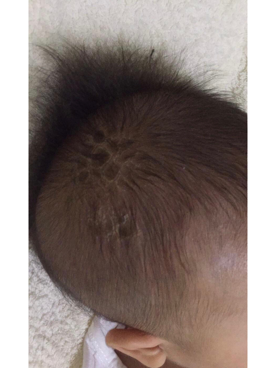 宝宝头上的结痂也称"乳痂"或"摇篮帽",这种结痂很常见.