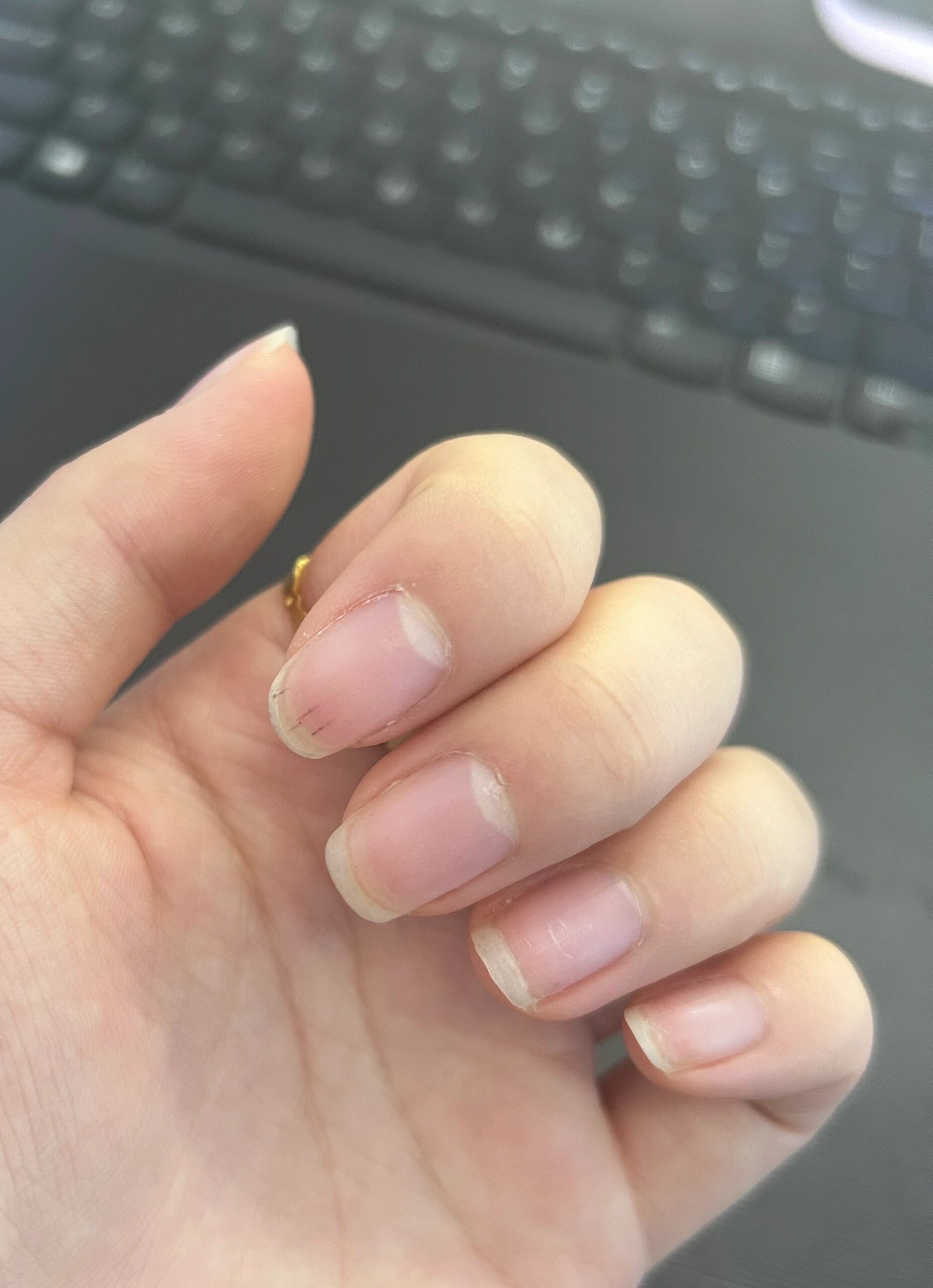 卸甲之后指甲有一条条黑线