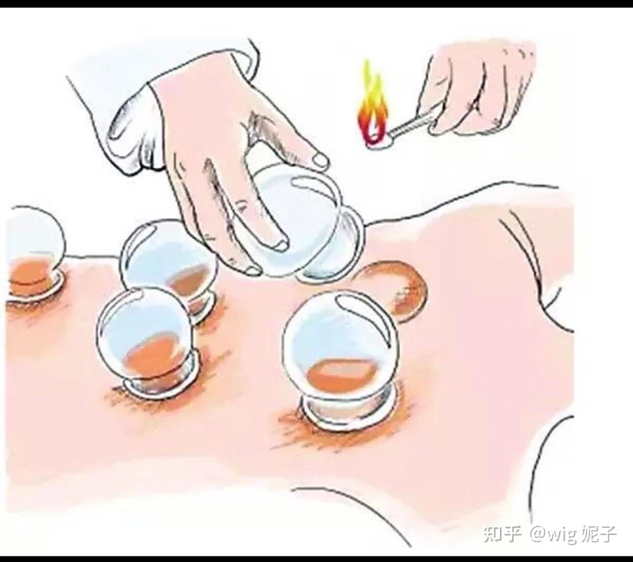 第一次拔罐第二天为什么很虚弱很困