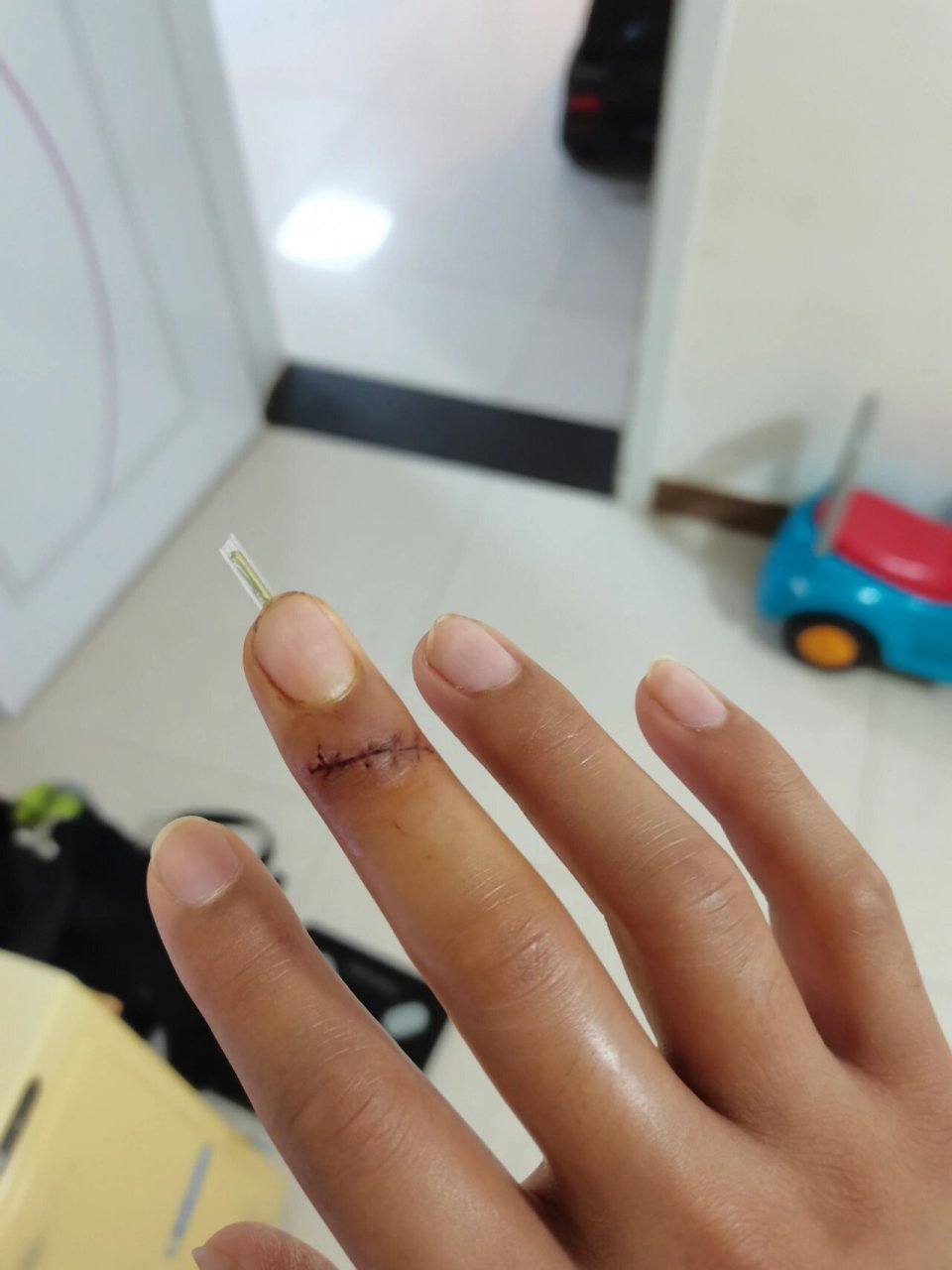 手指肌腱断裂手术 有问必答 2021年8月份,我蛾生日的时候带去河边玩