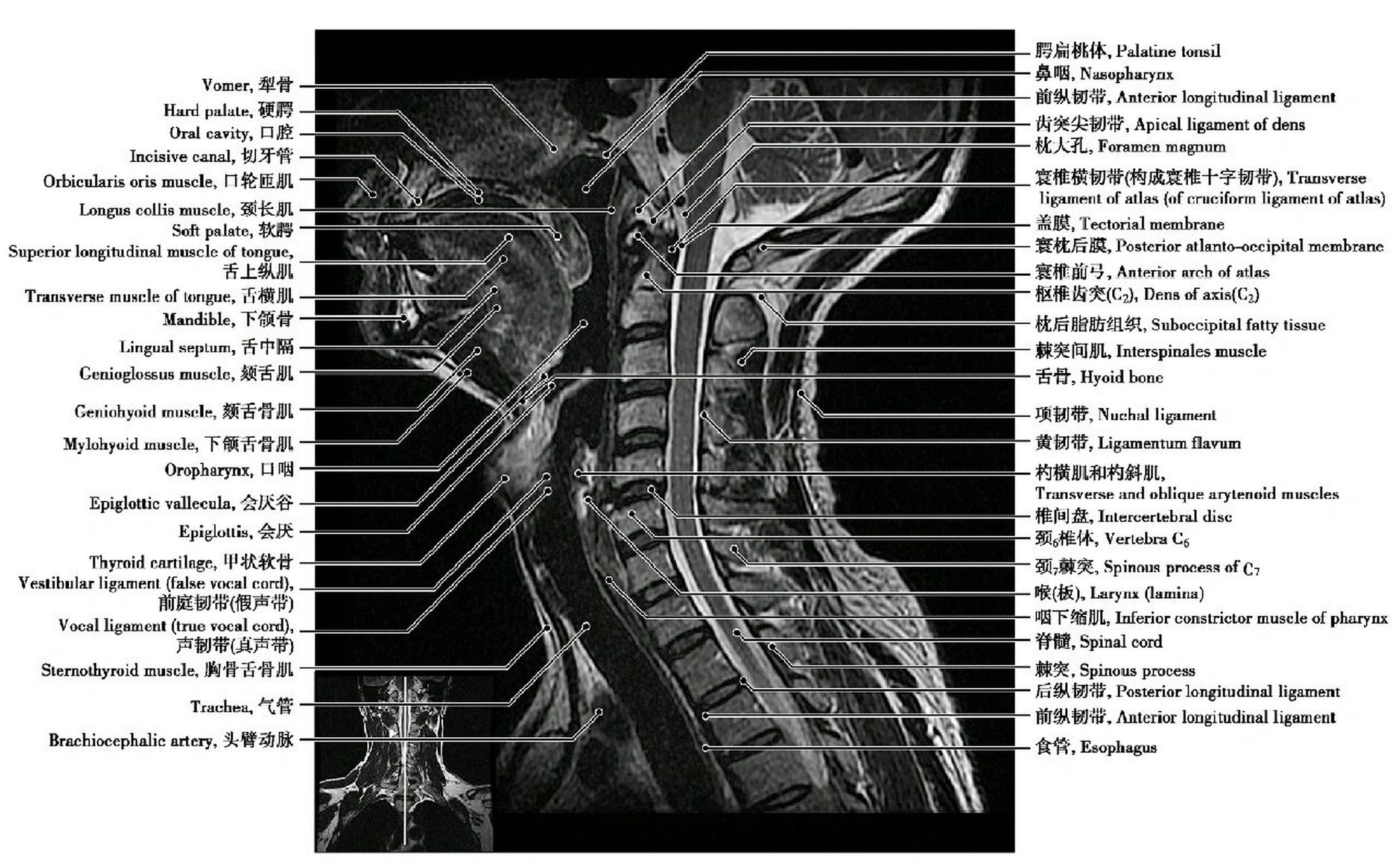 颈椎磁共振解剖图片