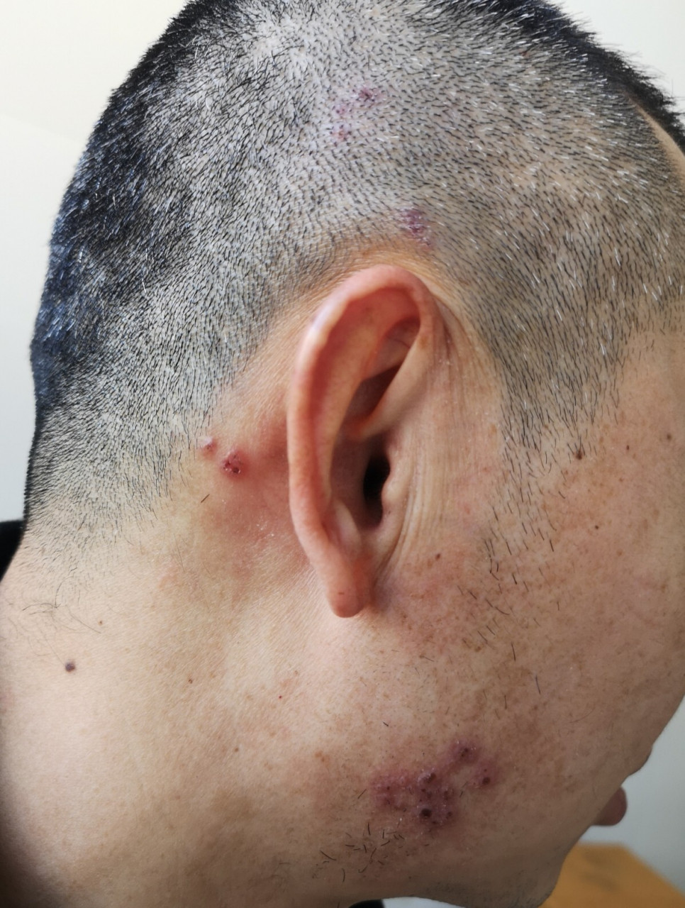 其实是"水痘—带状疱疹"侵犯神经所致.