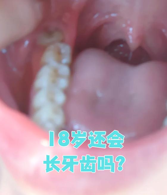 这种成年后长出的牙齿叫多生牙,也就是我们常说的智齿