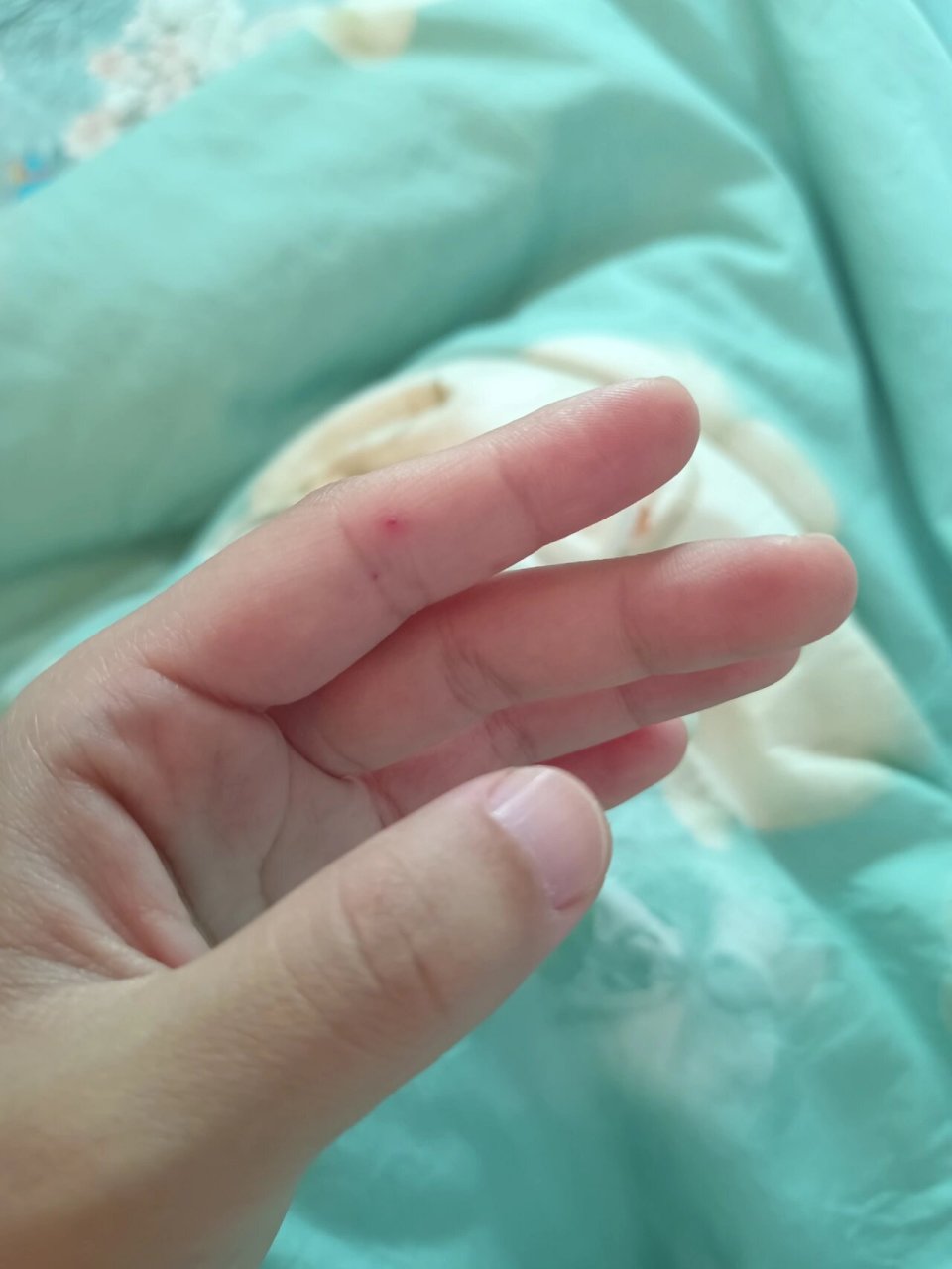 手掌上长了很多个小红点,有的变大变红了 姐妹们,有没有和我一样手上