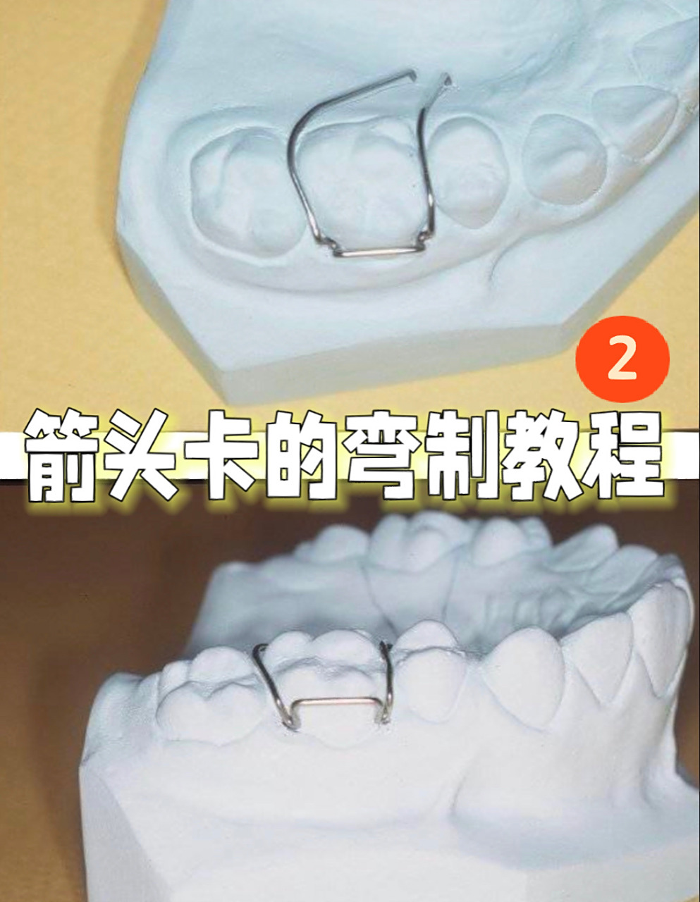 正畸必看之-箭头卡的弯制2 【正畸科进修】day 75 续上期箭头卡的弯制