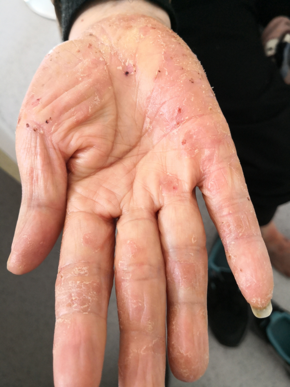 手掌足底干燥脱屑裂口角化过度症状.