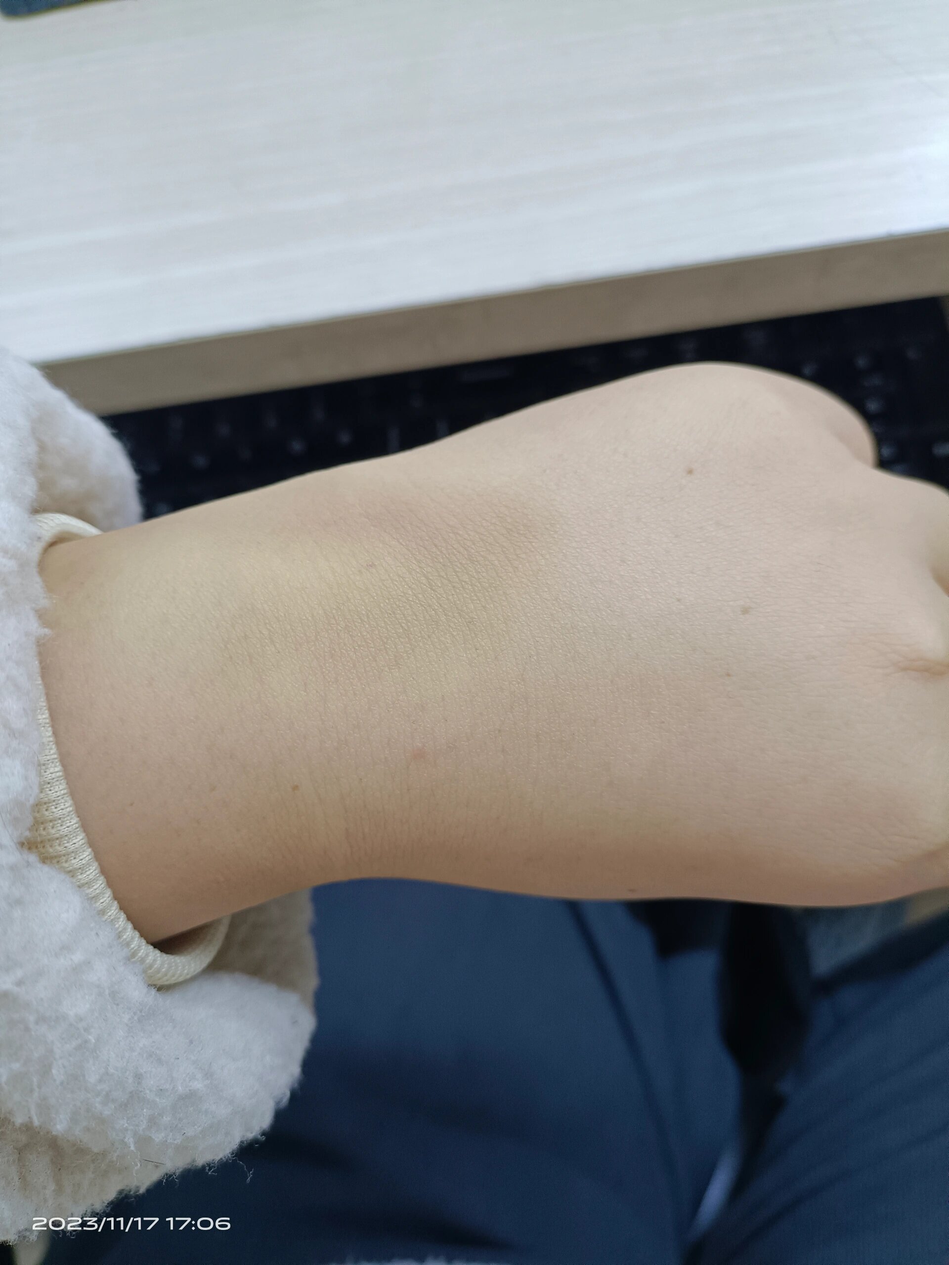 输液的时候鼓了个包,现在成这样了啥情况?