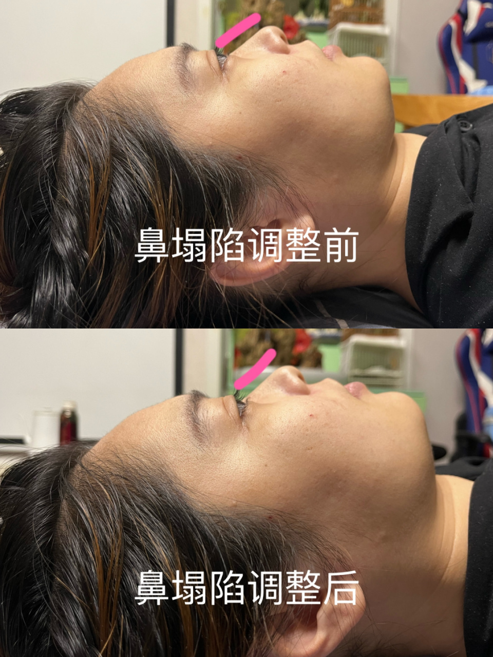 鼻塌陷手法调整一次对比 #徒手脸部整形##整颅术