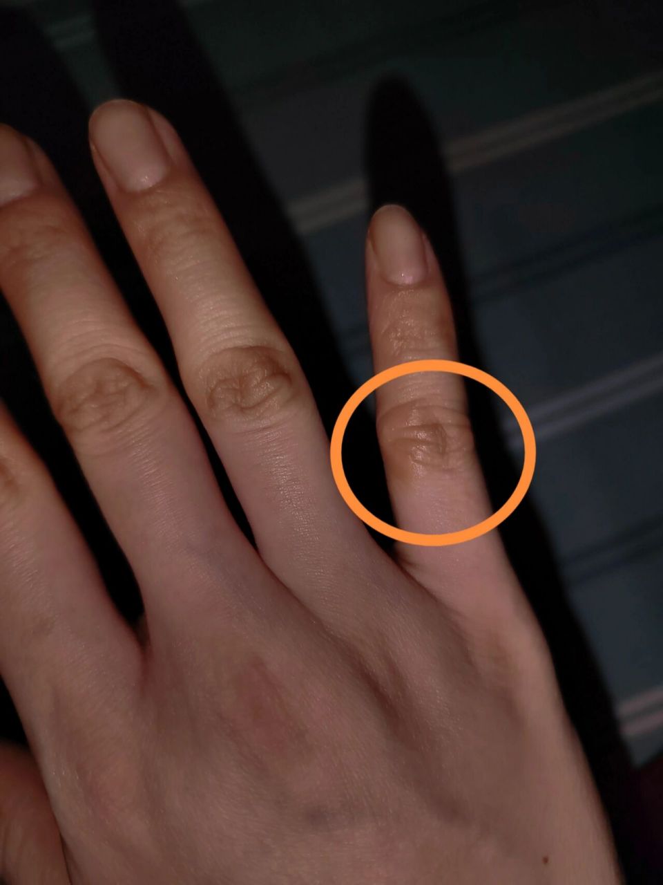 指关节皮肤变硬 右手小拇指指关节的皮肤突然颜色变深并增厚,指甲掐也