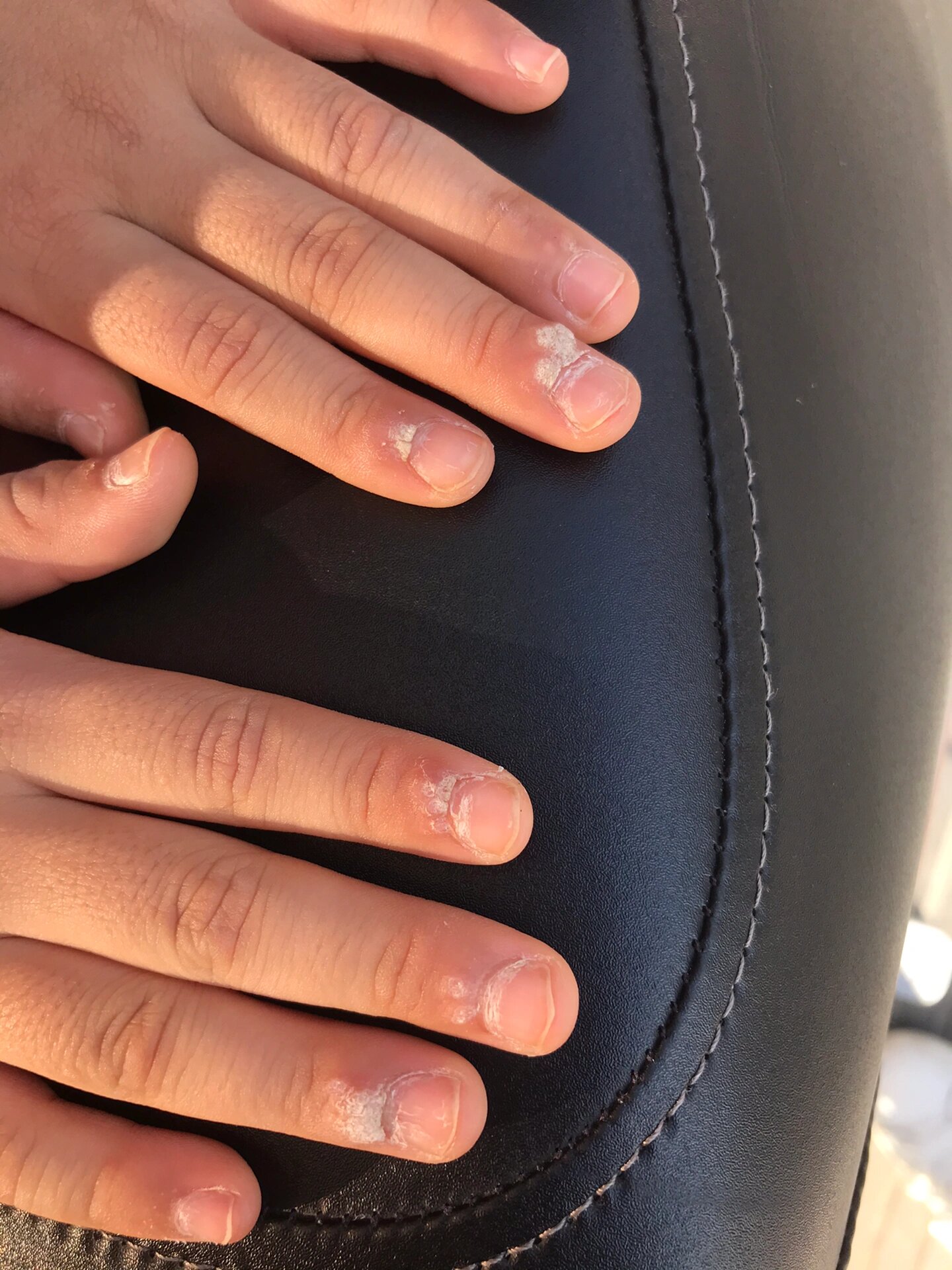 儿童甲周疣寻常疣终于好啦 感谢万能的,孩子两三岁时候手指周围就长了