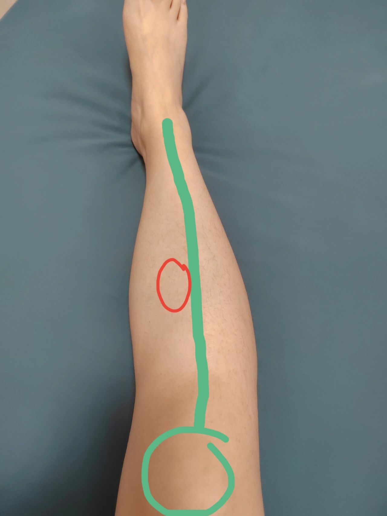 跳绳小腿内侧疼 跳绳跳了两周多,突然小腿内侧胫骨边疼,而且只有右腿