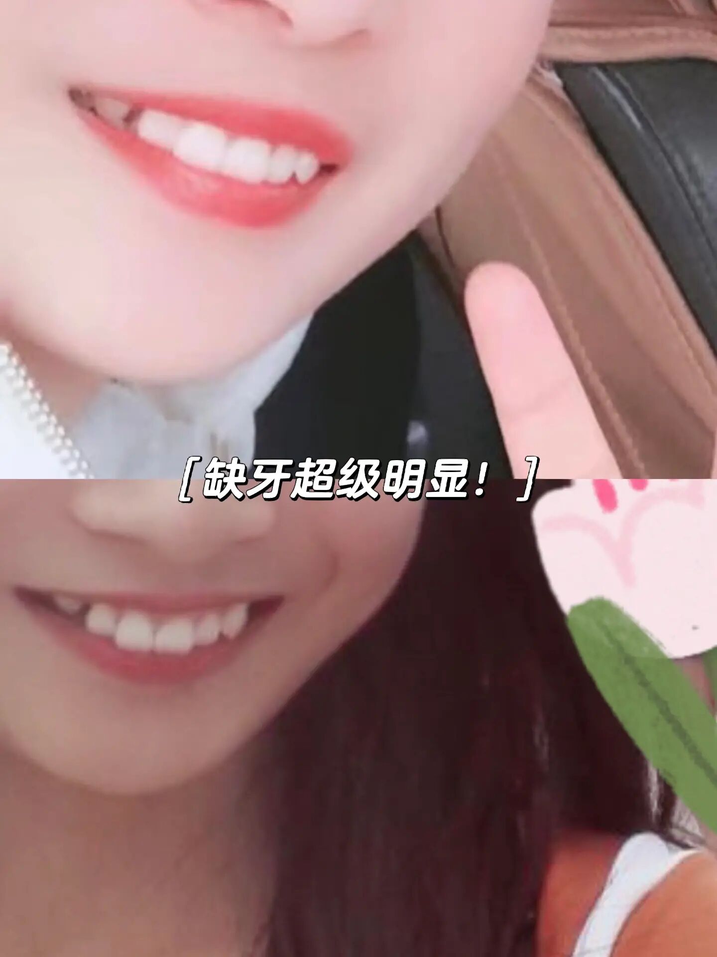 虎牙埋伏牙,拔出还是牵引?