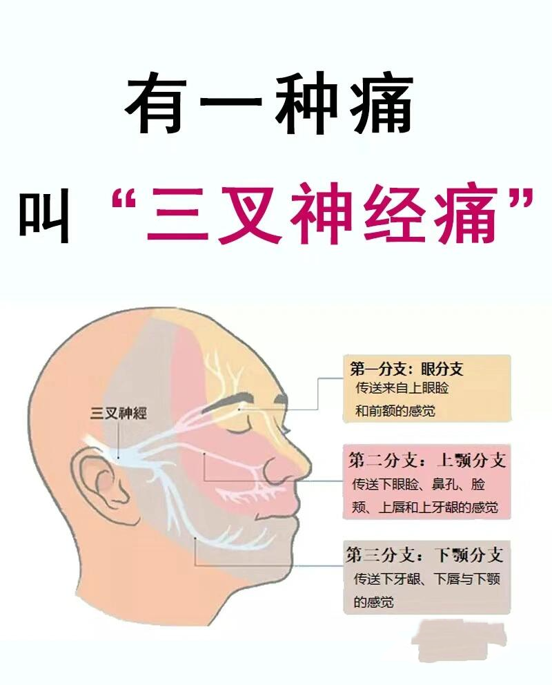 三叉神经痛