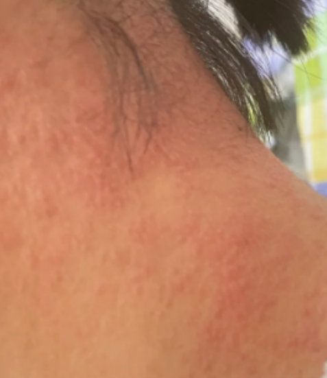 脖子上突然起很多疙瘩,这种情况很常见