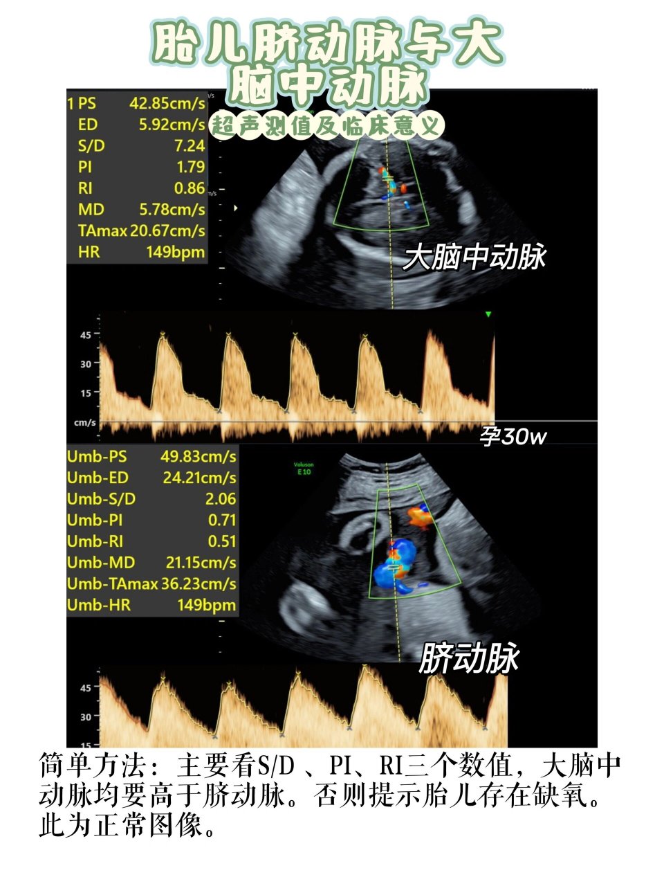 胎儿脐动脉与大脑中动脉血流的测值与意义 脐动脉血流是超声常见的一