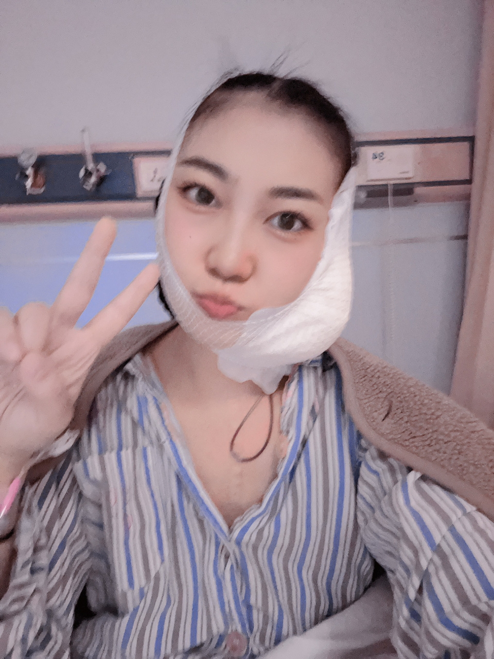 再也不见 腮腺混合瘤  再也不见 今天是拆线后的第7天,术后第22天
