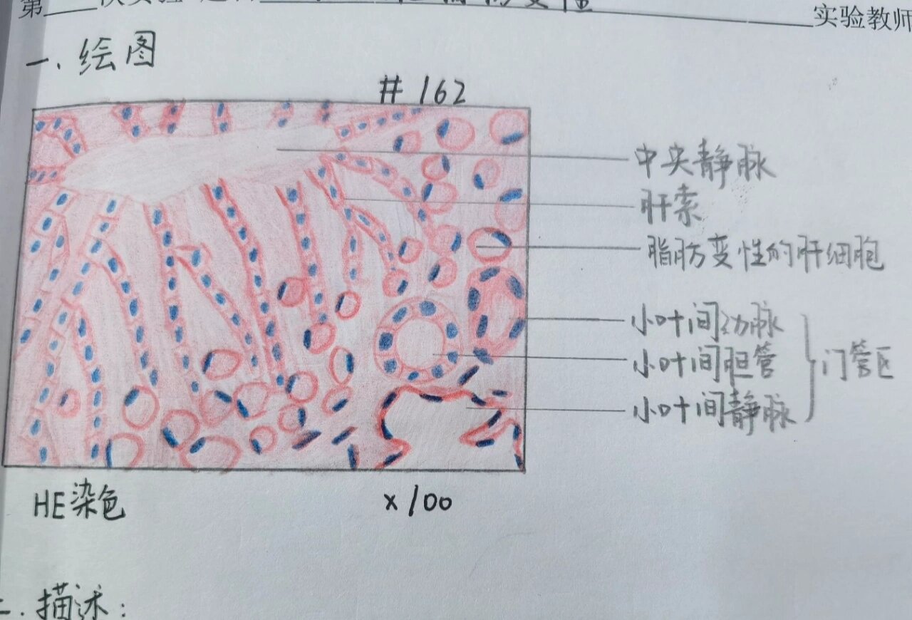 肝脂肪变红蓝手绘图片