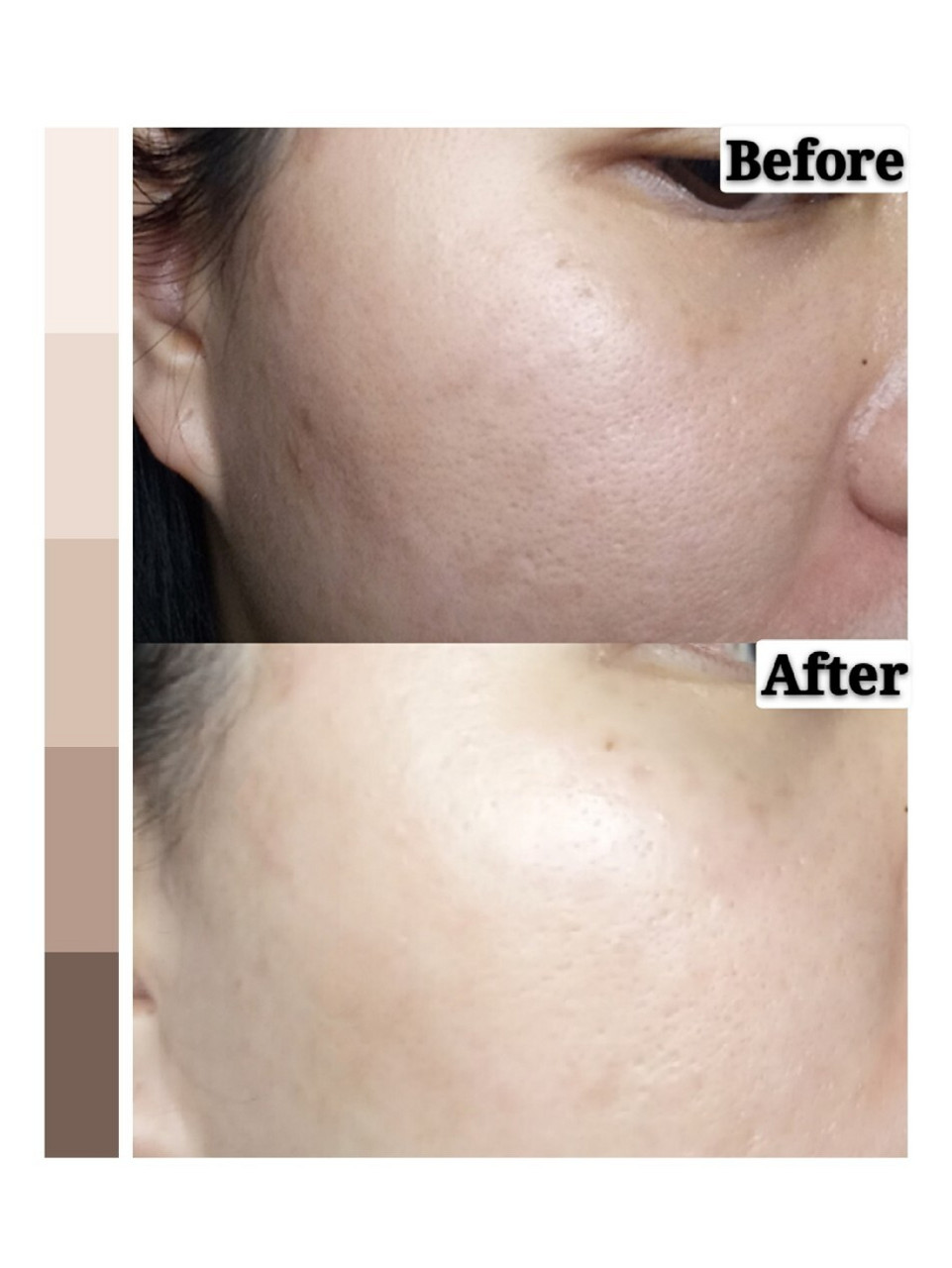 很多人都建议痘肌要刷酸,我们一般常见的刷酸有4种,果酸,壬二酸,杏仁