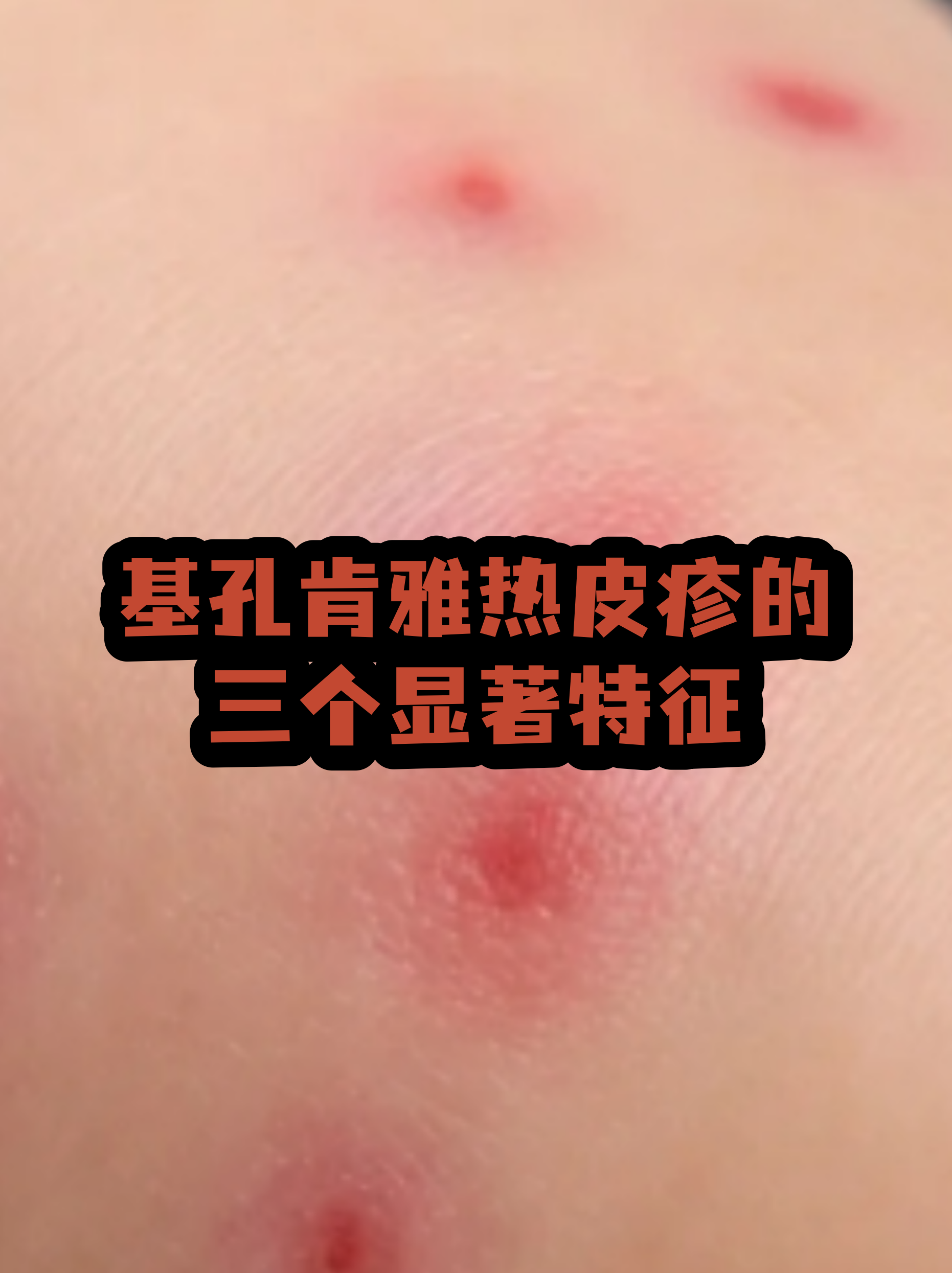  蚊虫病毒感染是什么症状有脸红发热(蚊虫感染皮肤用什么药)