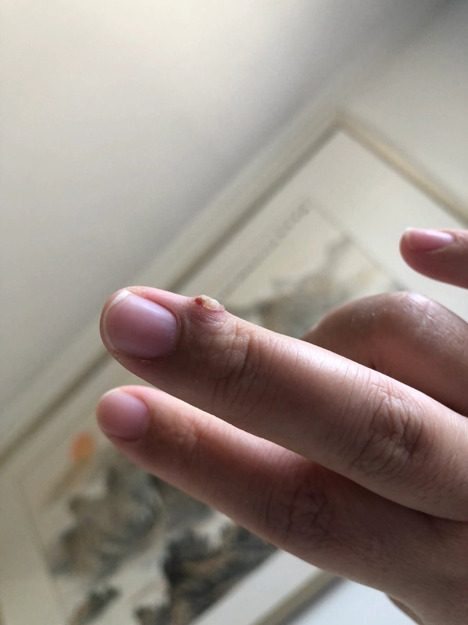 盐敷法下的孕期长的化脓性肉芽肿 敷了三天 变化不大 表皮硬壳变软被