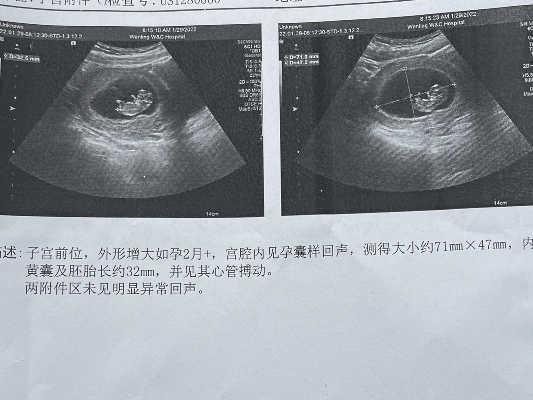 怀孕10周女孩孕囊图图片