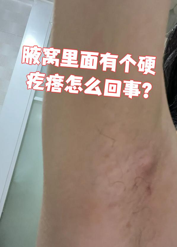 皮肤纤维瘤会在皮肤下形成硬结节,可能长在腋窝