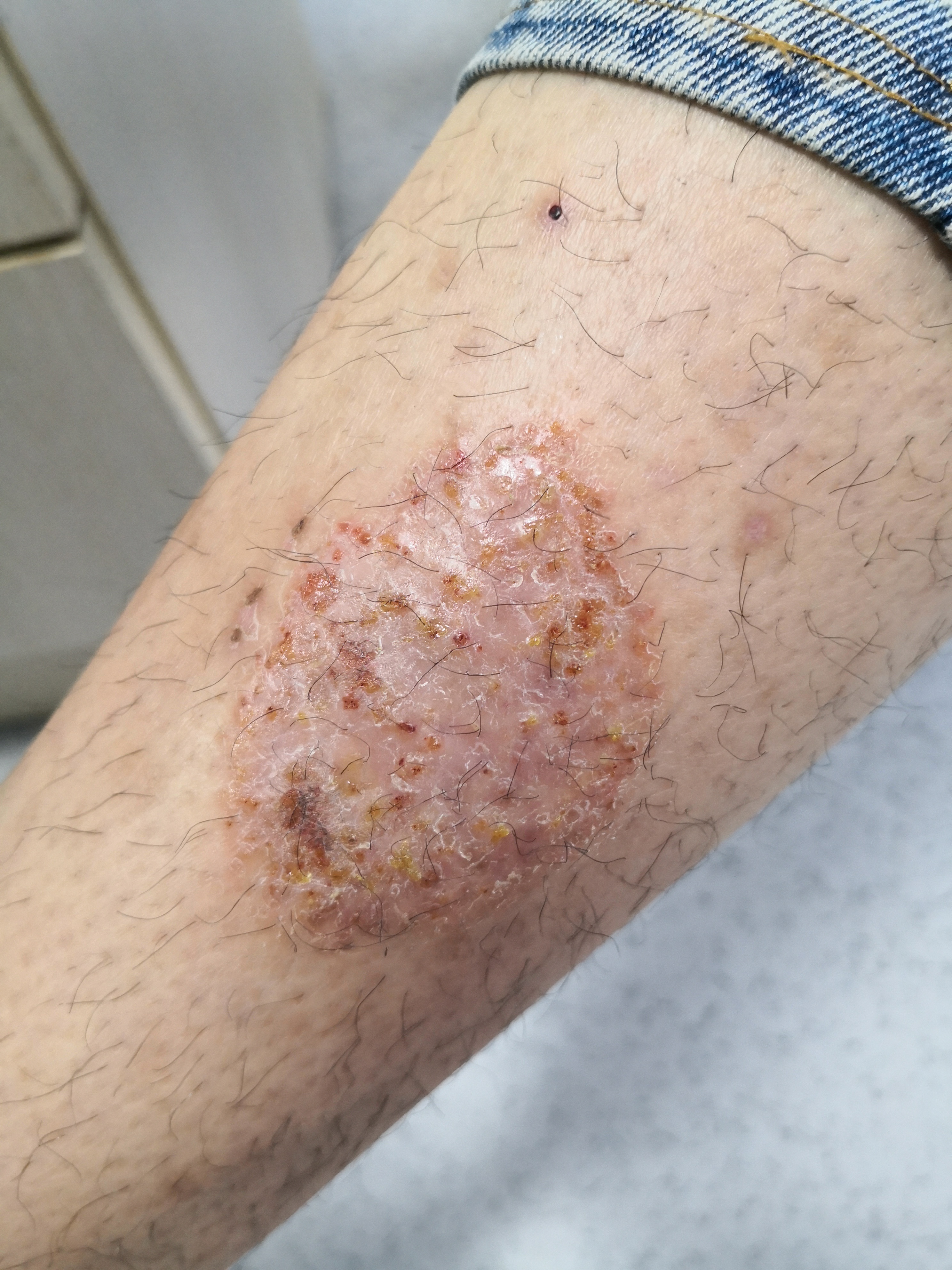 小腿湿疹症状.斑块状湿疹.真菌阴性#湿疹