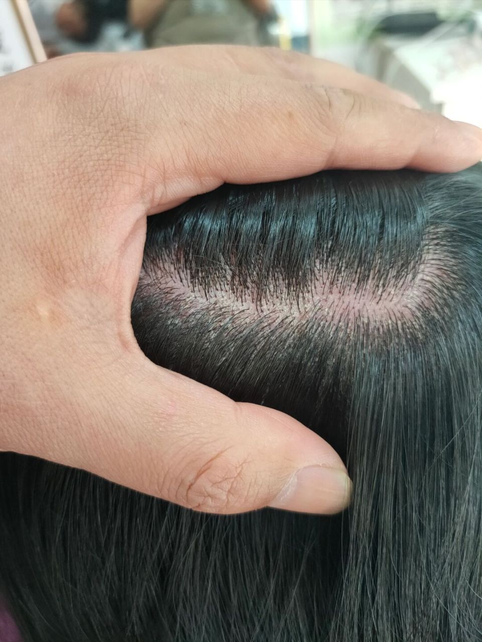 一直没有调理好 别人介绍选择了我家, 她的头皮有毛囊炎,头屑,毛囊