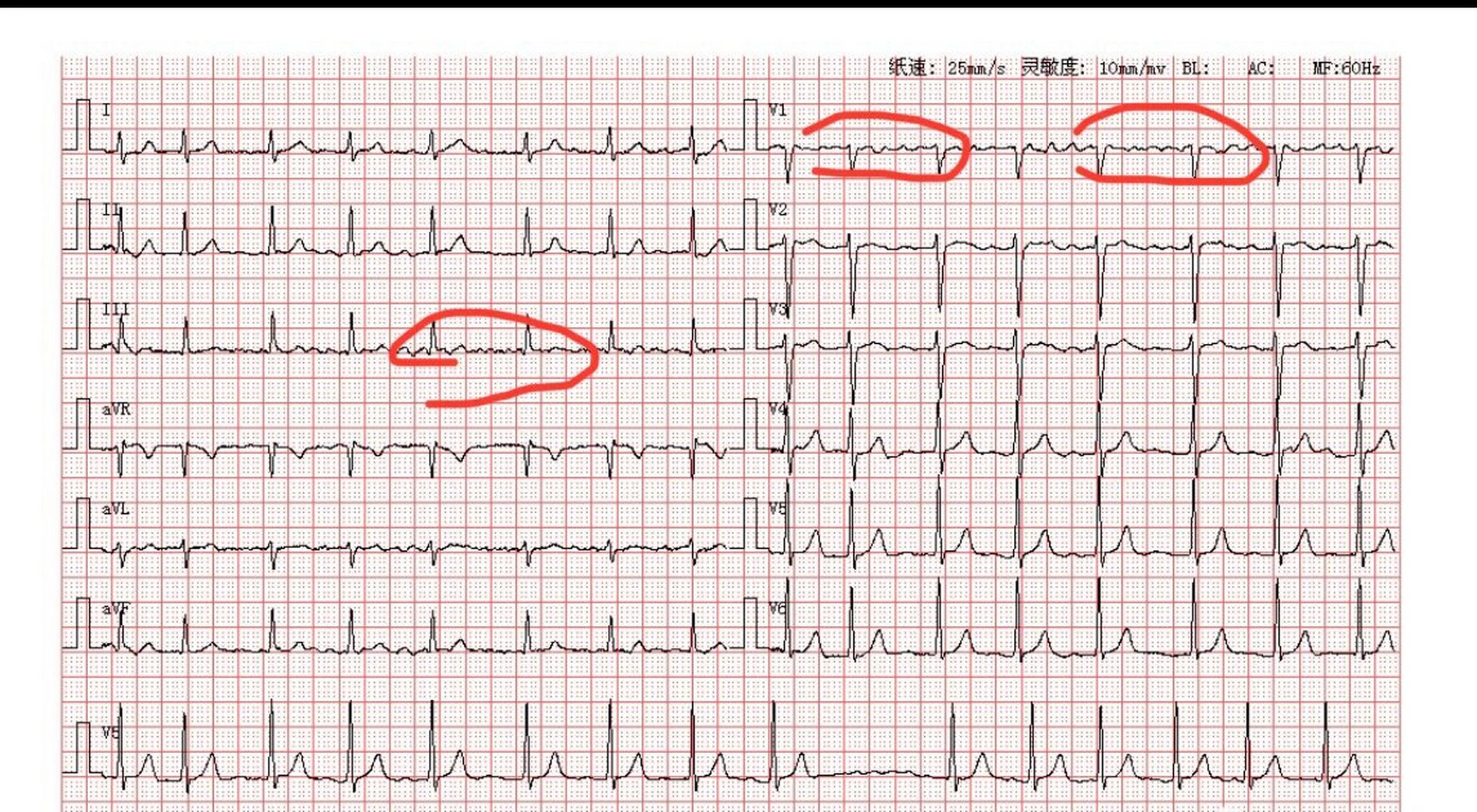 f波心电图长什么样图片