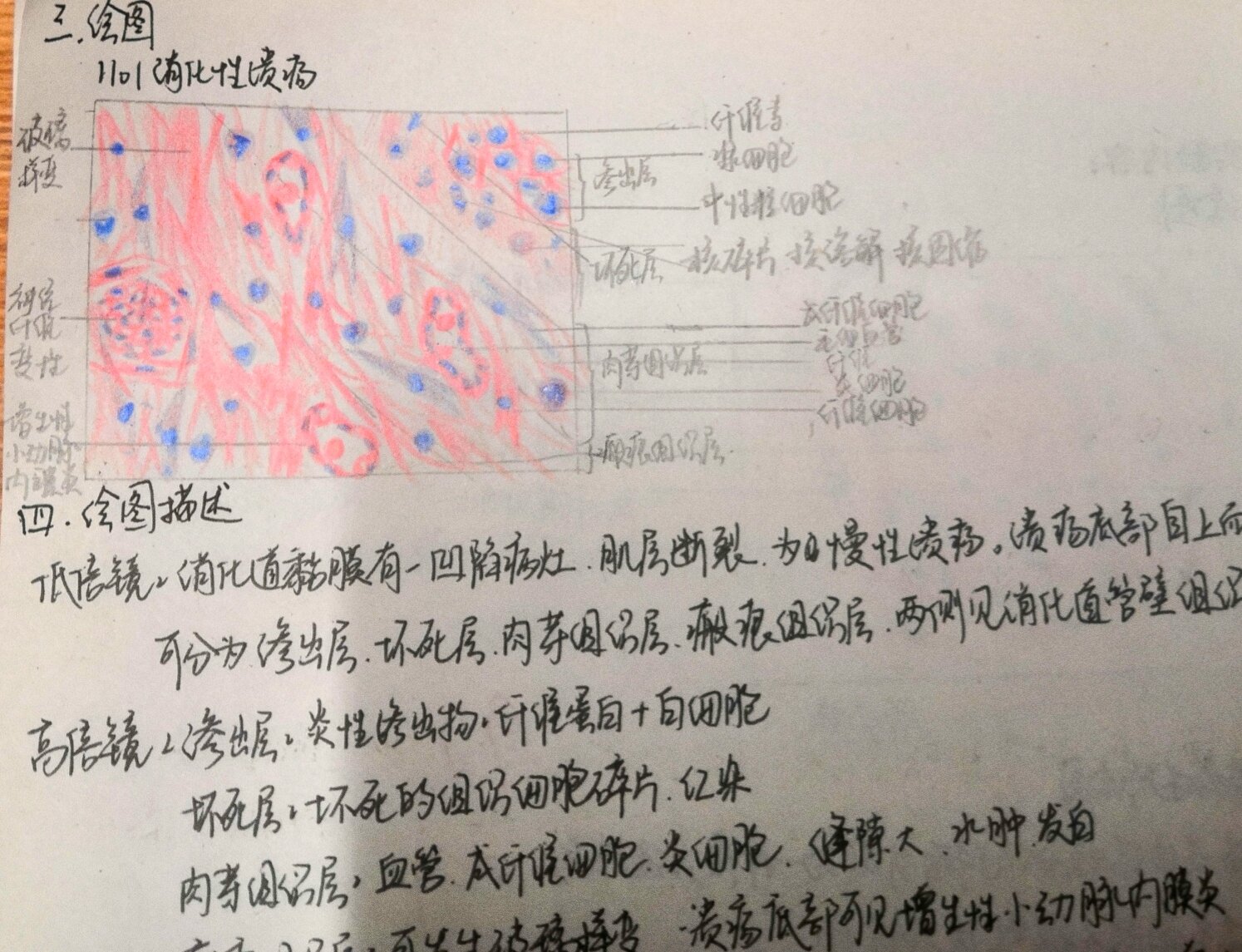 胃溃疡病理手绘图图片