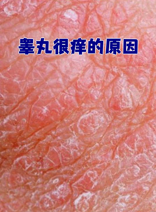 阴囊湿疹通常是因为会阴部长期潮湿或受到摩擦刺激