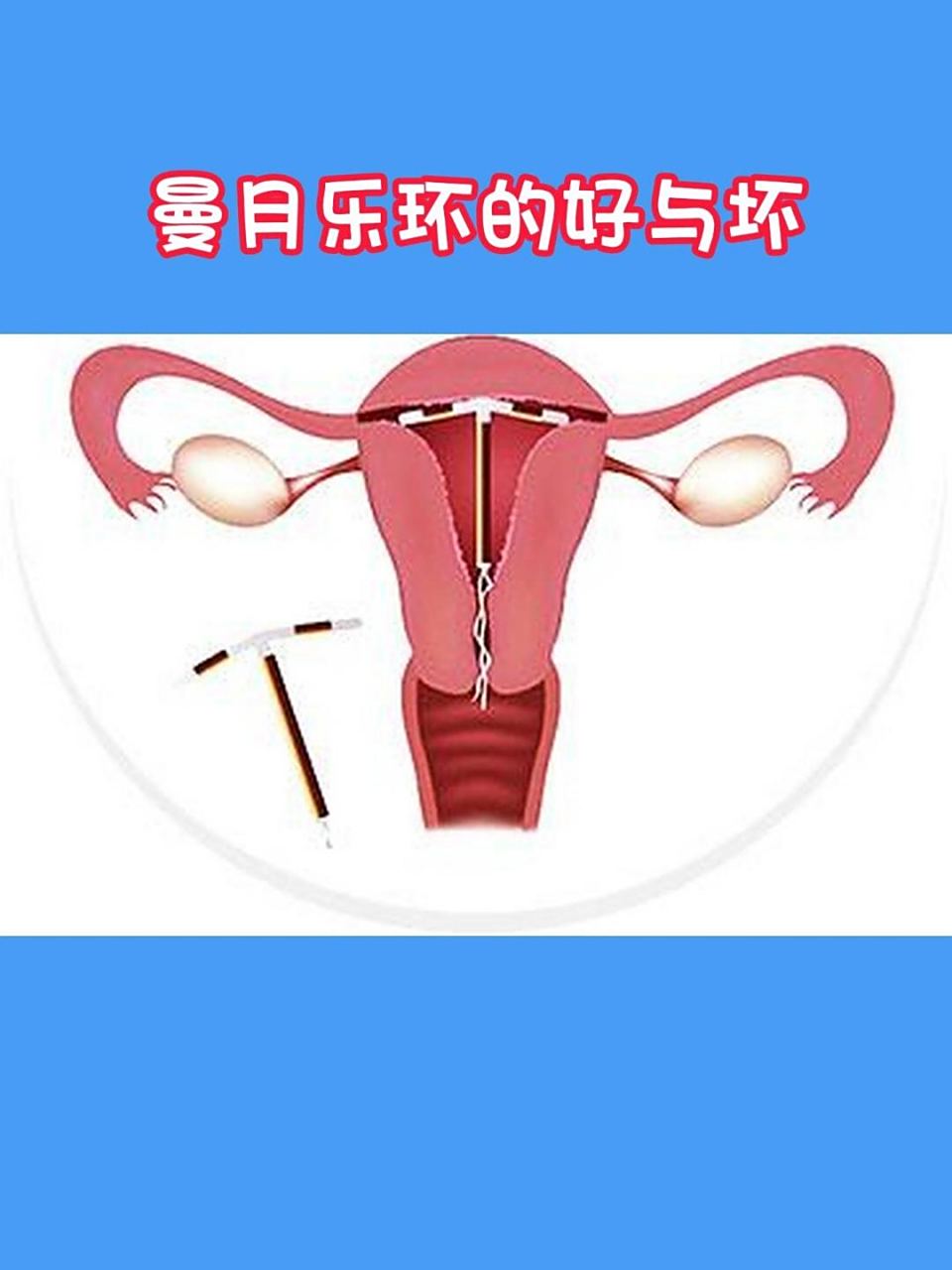 曼月乐环的好与坏! 1