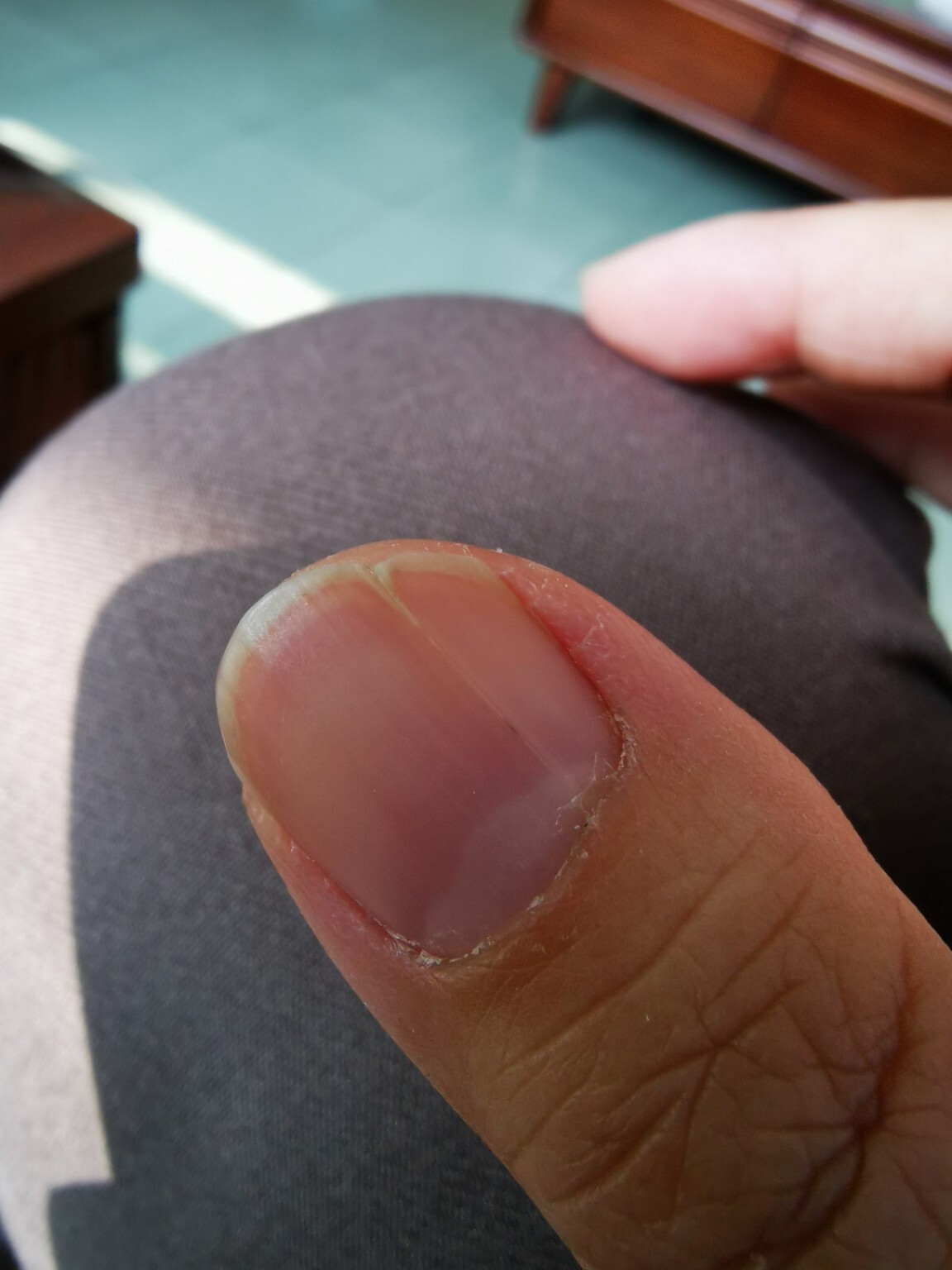 我的拇指指甲长出来就是裂开的,也不疼不痒.