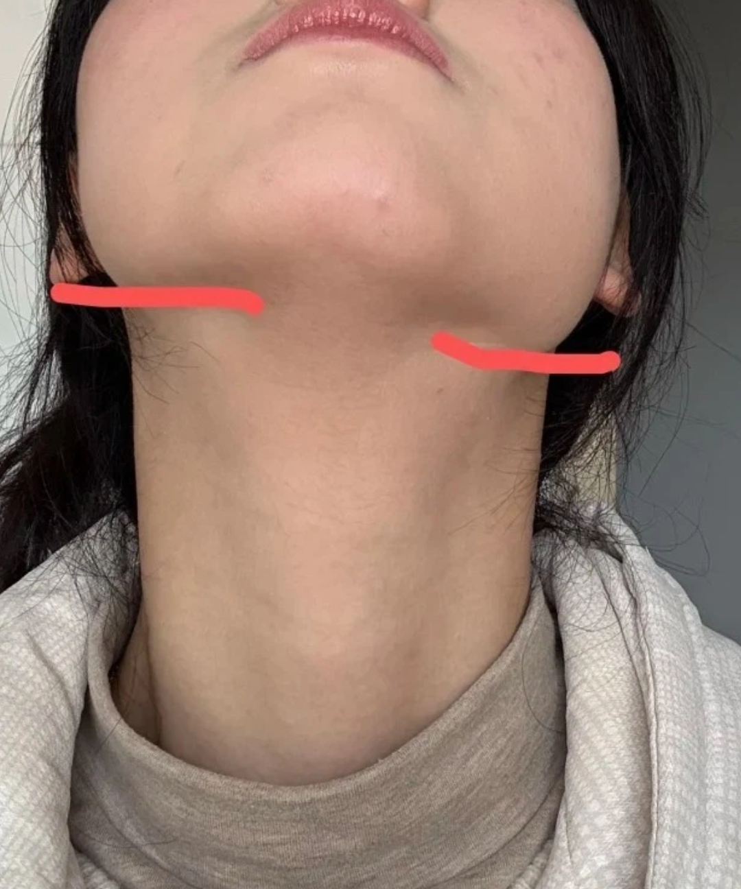 下颌骨不对称可能由先天发育不良,不良咀嚼习惯,不良睡姿,骨折或颞