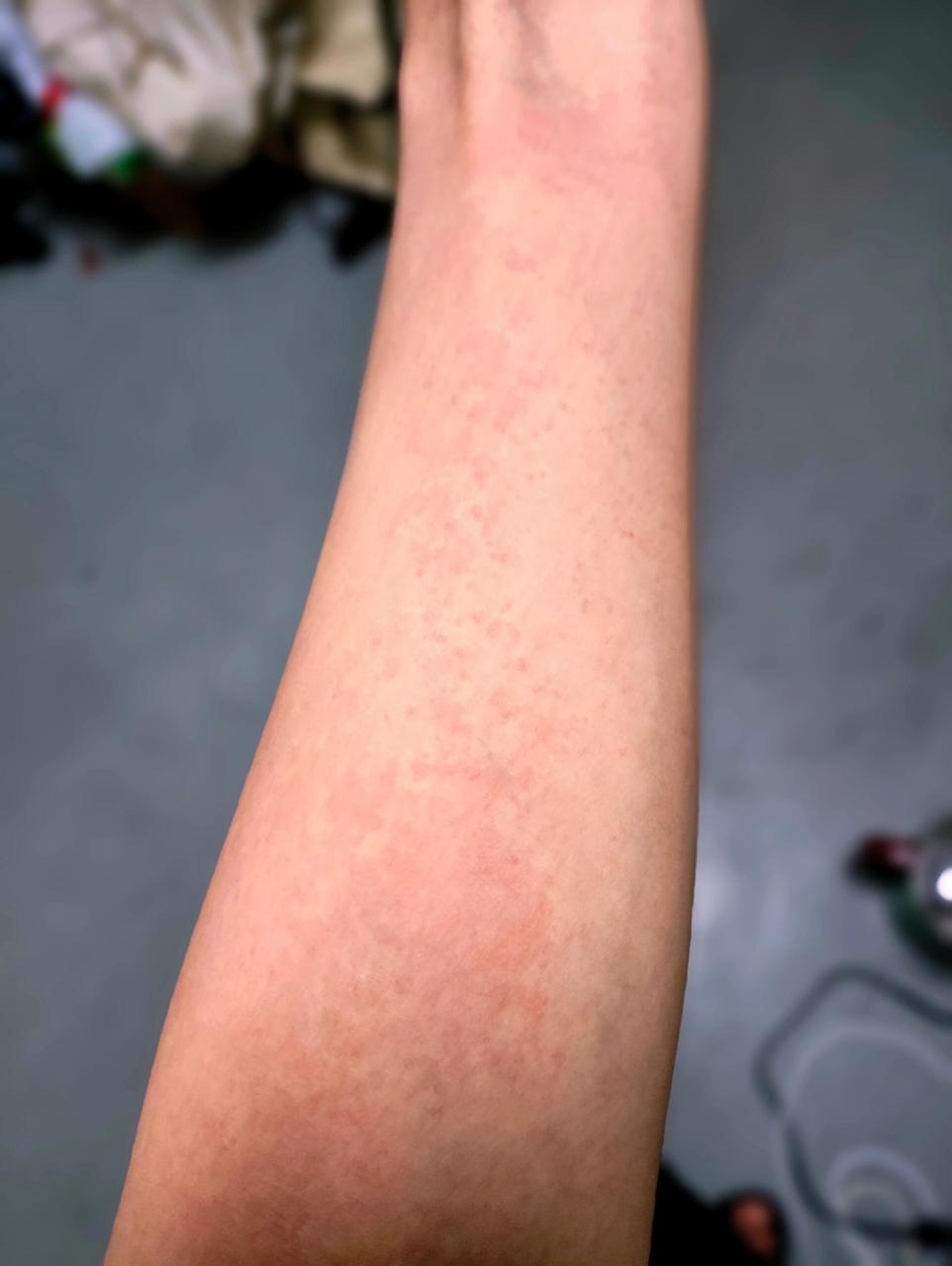 用了素颜霜第二天手臂大过敏… 难道是我没有卸干净?