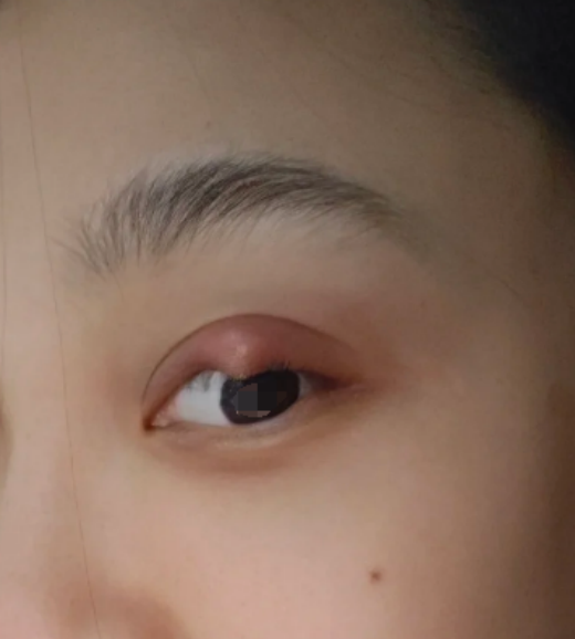麦粒肿是化脓性细菌侵入眼睑腺体引起的急性炎症,通常会出现白色脓 