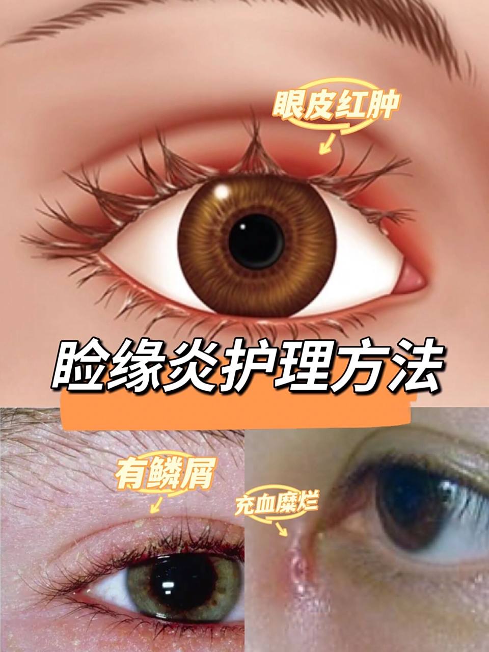 这一篇带大家正确认识97睑缘炎,明确病因,才能针对用药99 - 97