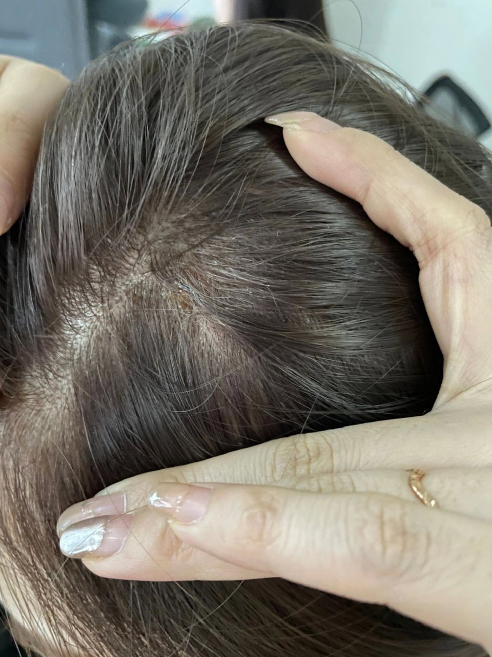 漂发头皮结痂了 应该怎么办啊姐妹们 上周日硬着头皮去漂染奶茶发色去