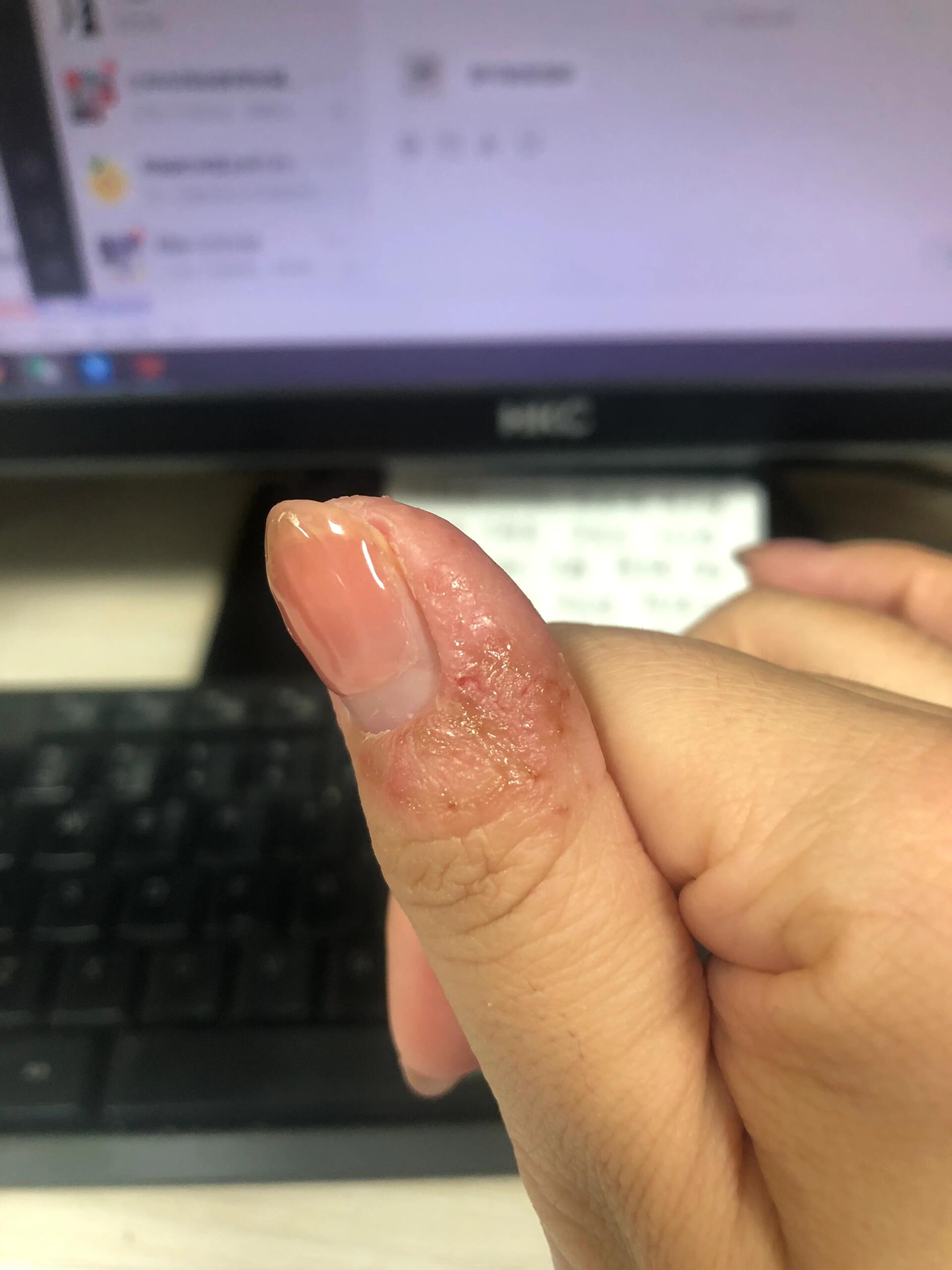 三个月治疗掌趾脓包记录