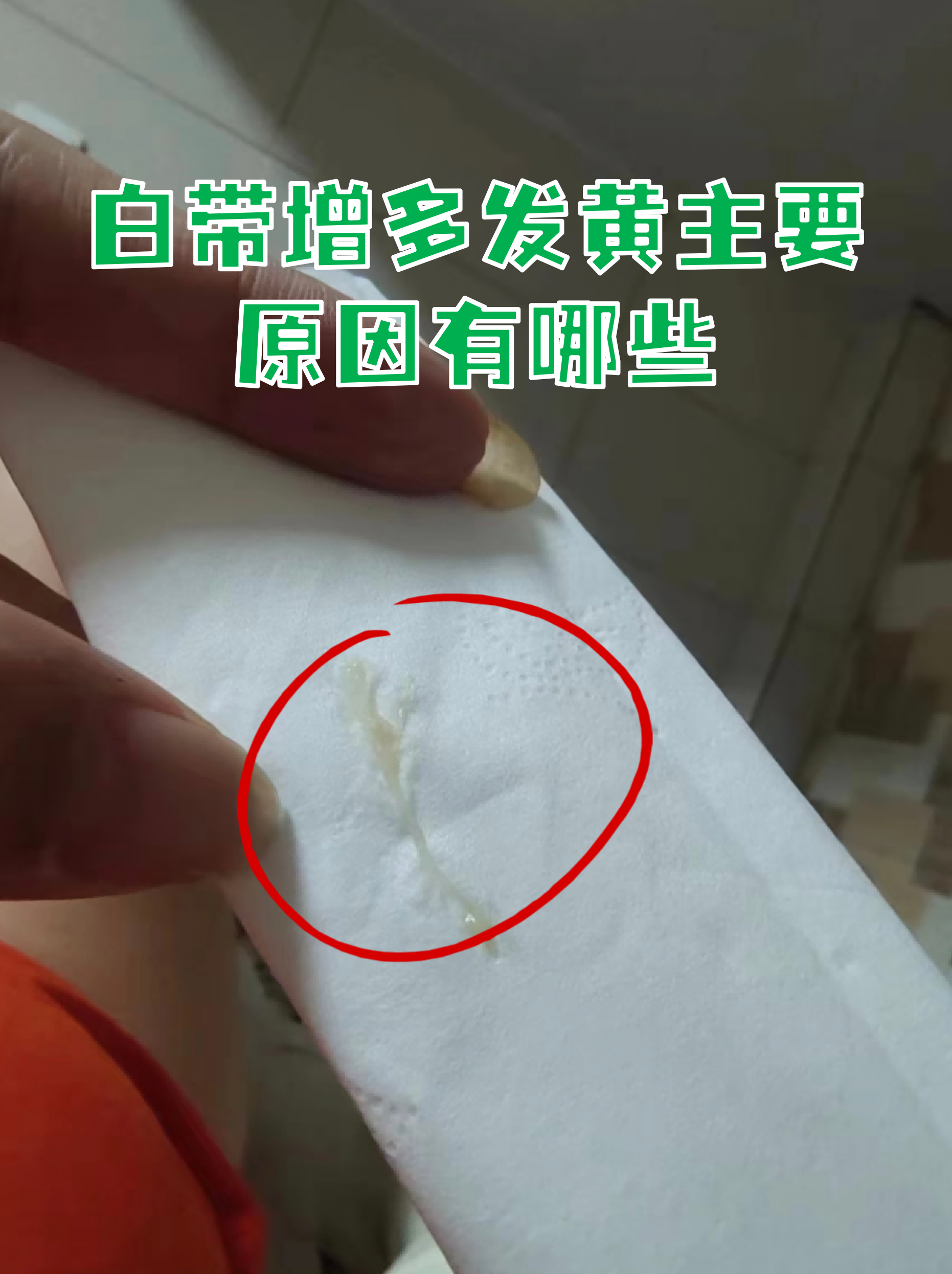 白带增多发黄主要原因有哪些