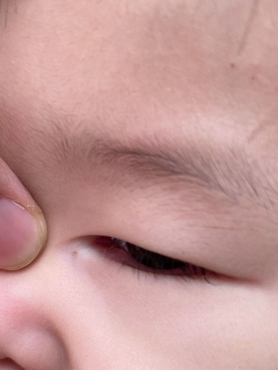 有人了解宝宝先天性泪囊瘘吗? 需要手术吗?可以自愈吗?