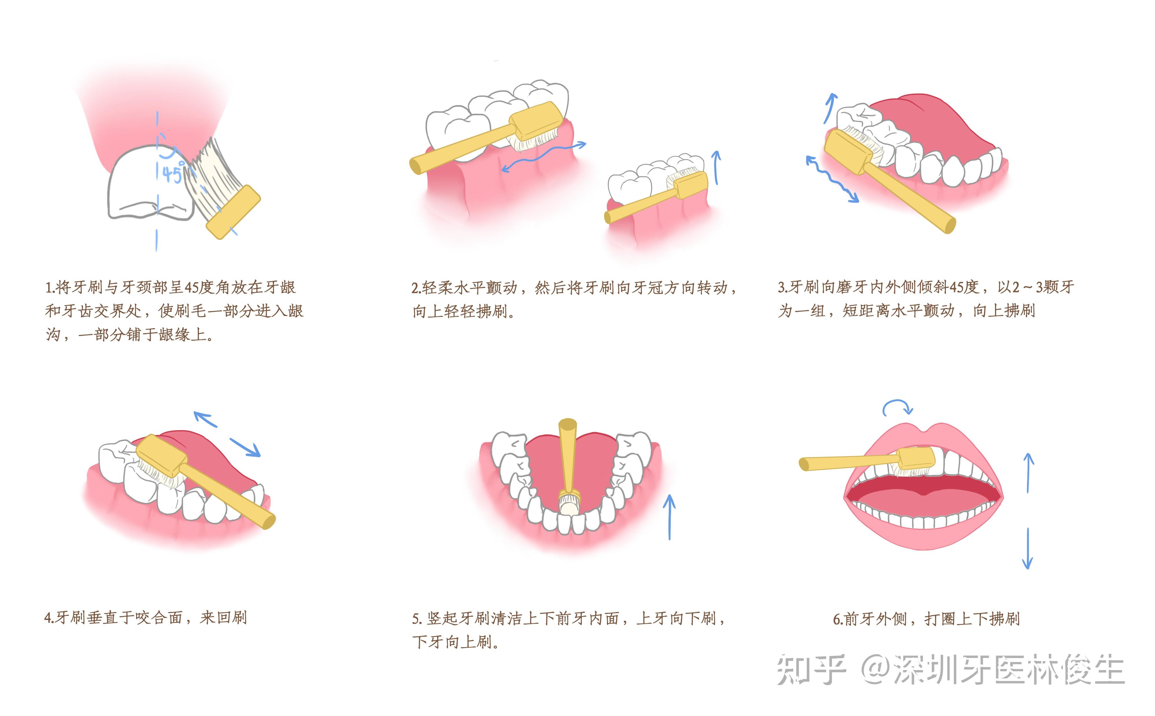 拔牙一年了做种植牙会不会太晚