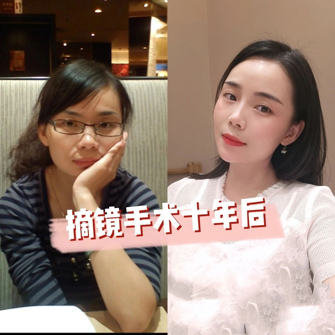 近视手术十年后!后遗症?回退?