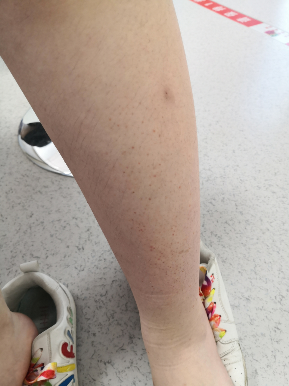 过敏性紫癜症状.#解决皮肤问题专注皮肤美容##过敏性紫癜