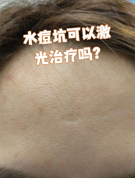 水痘坑是水痘痊愈后留下的疤痕,通常是因为抓挠引起的