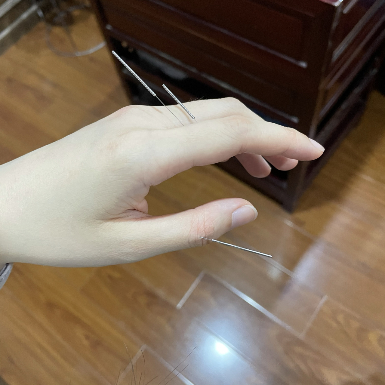 针灸的医生附赠了我3针,说是帮助(缓解)湿疹.