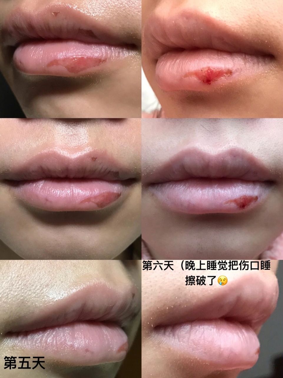 记录我烂嘴巴的恢复史(三) 从自己确诊当天开始记录,修复时每日一拍